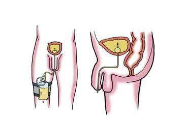 Catheter in bladder
